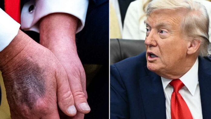 La salud de Donald Trump despierta rumores e inquietudes
